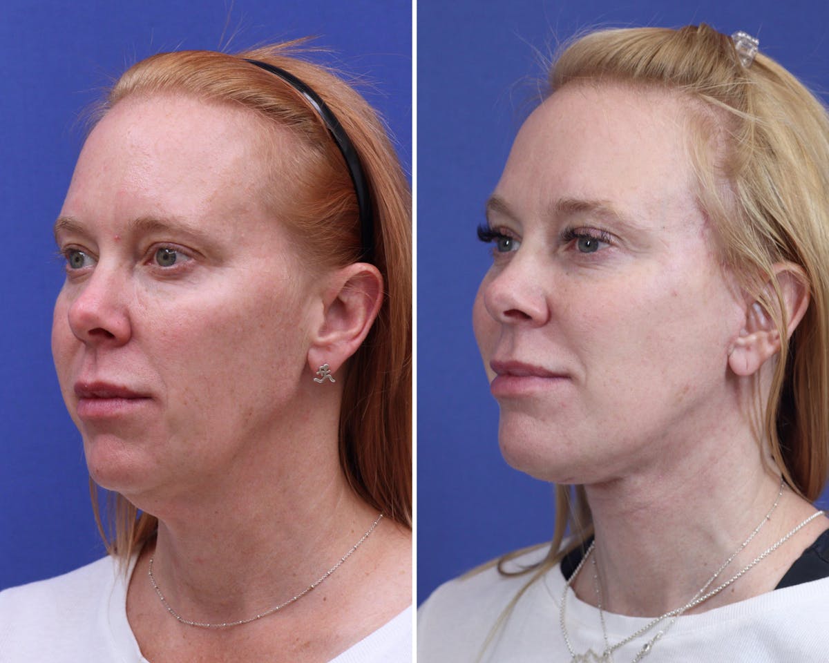 Facelift Before & After Gallery - Patient 118138 - Image 2