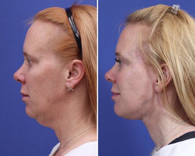 Facelift Before & After Gallery - Patient 118138 - Image 1