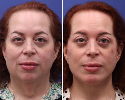 Facelift Before & After Gallery - Patient 434985 - Image 1