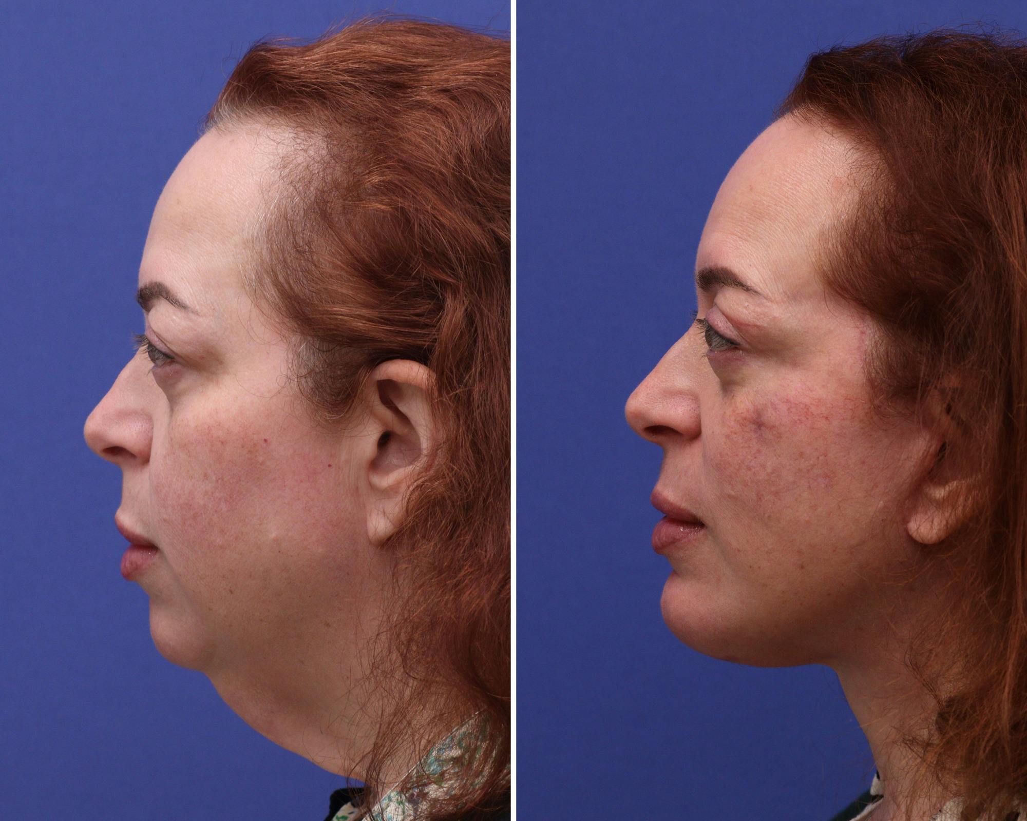 Face Before & After Gallery - Patient 365119 - Image 3