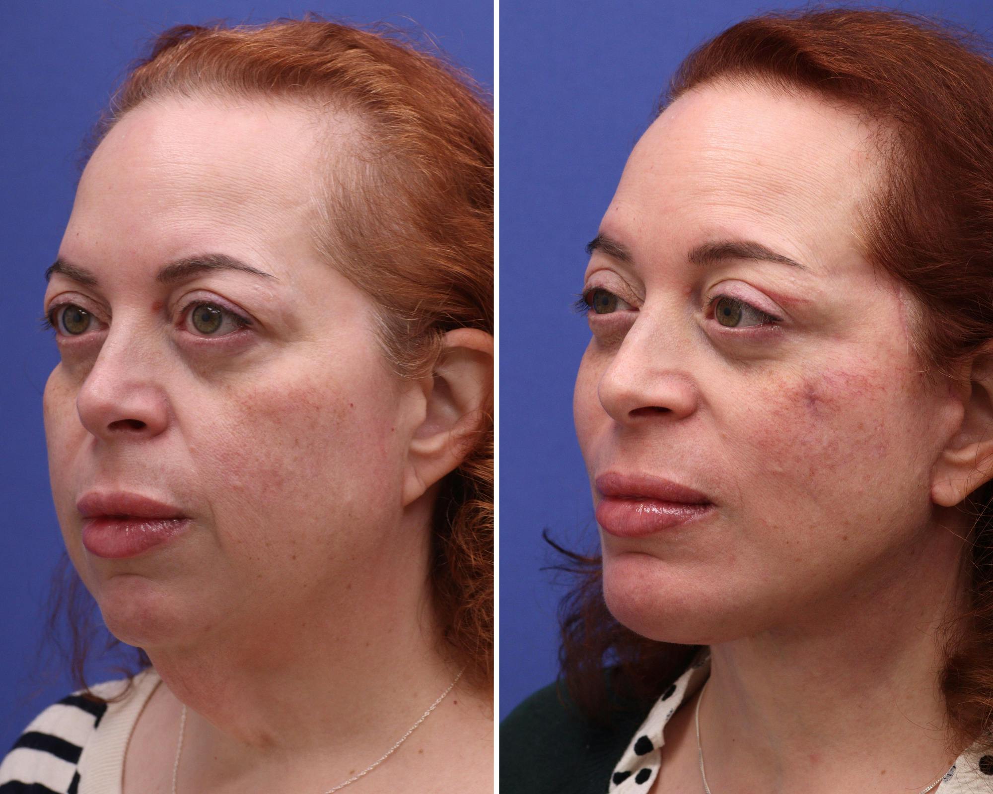Face Before & After Gallery - Patient 365119 - Image 2