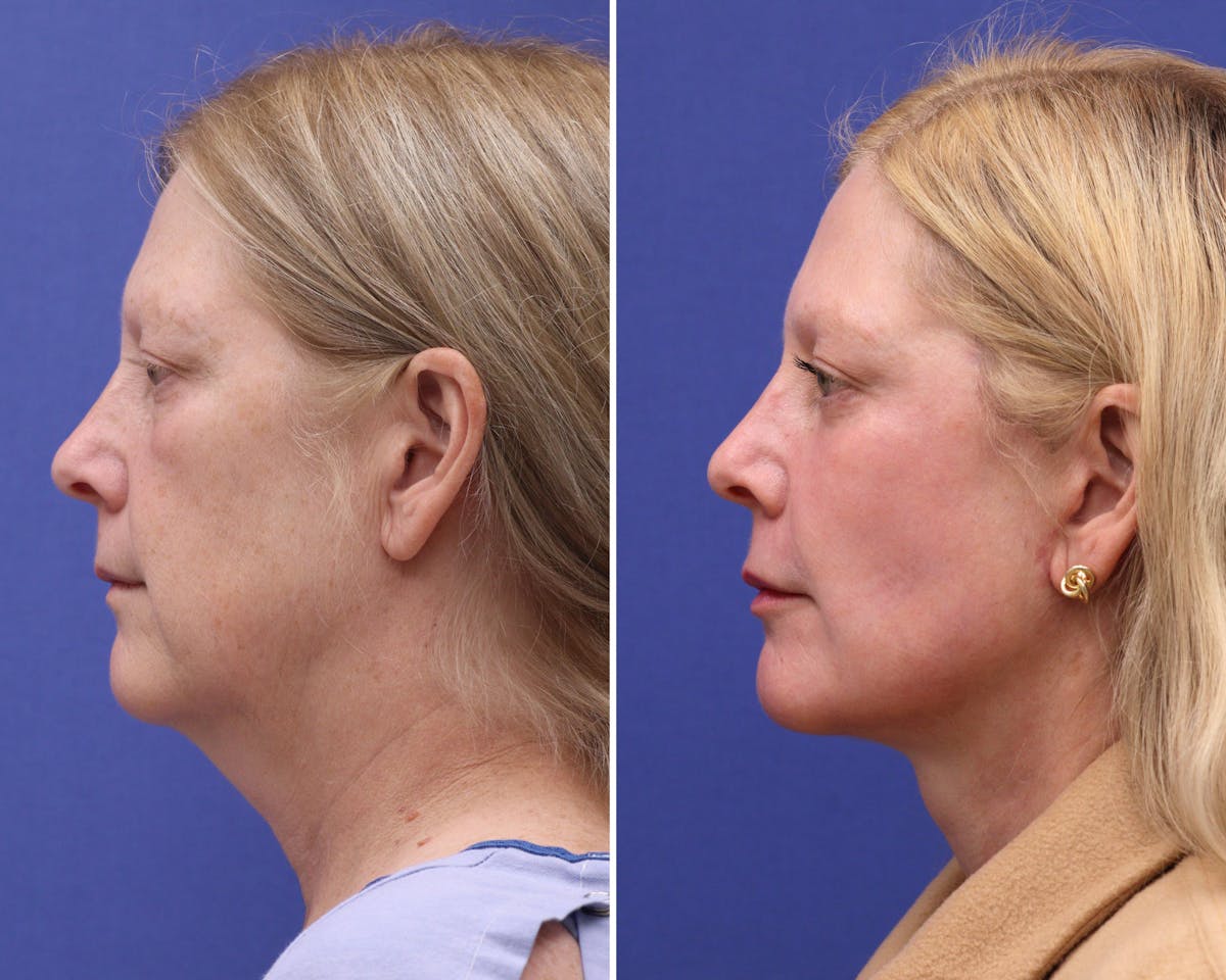 Facelift Before & After Gallery - Patient 220924 - Image 2