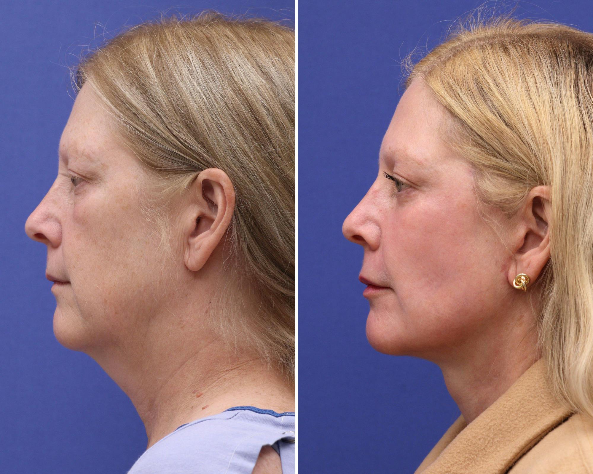 Face Before & After Gallery - Patient 214242 - Image 2