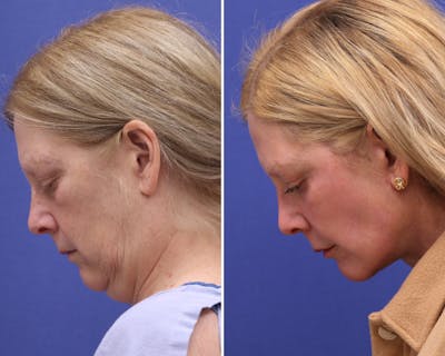 Facelift Before & After Gallery - Patient 220924 - Image 1