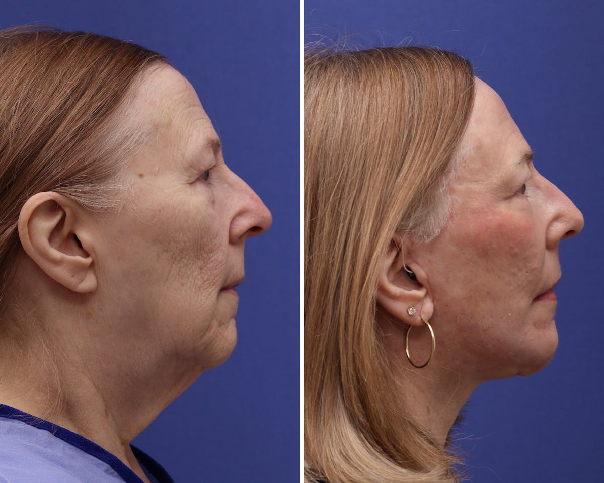 Facelift Before & After Gallery - Patient 252628 - Image 2