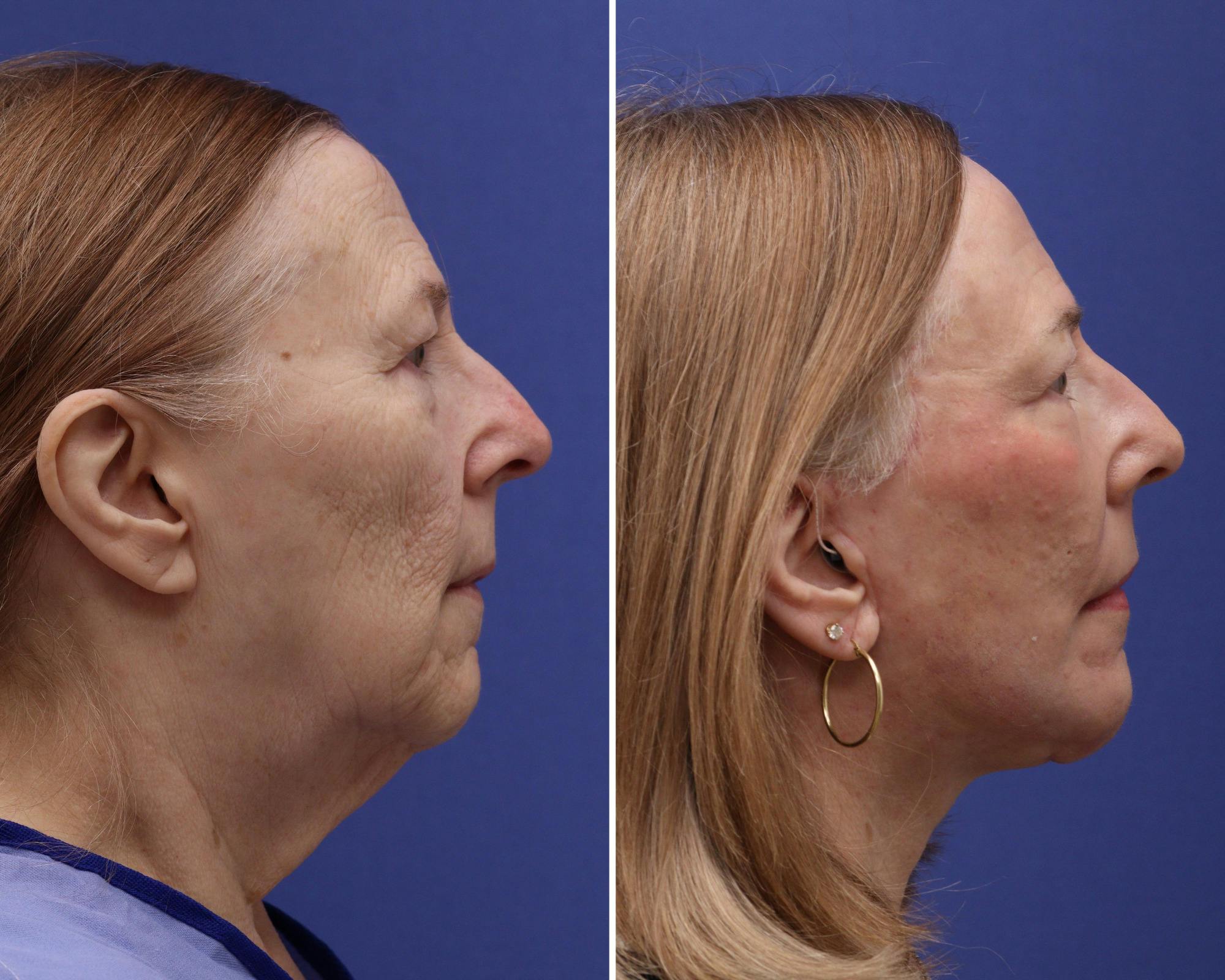 Face Before & After Gallery - Patient 305634 - Image 2