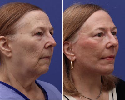 Facelift Before & After Gallery - Patient 252628 - Image 1