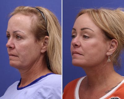 Facelift Before & After Gallery - Patient 376692 - Image 1