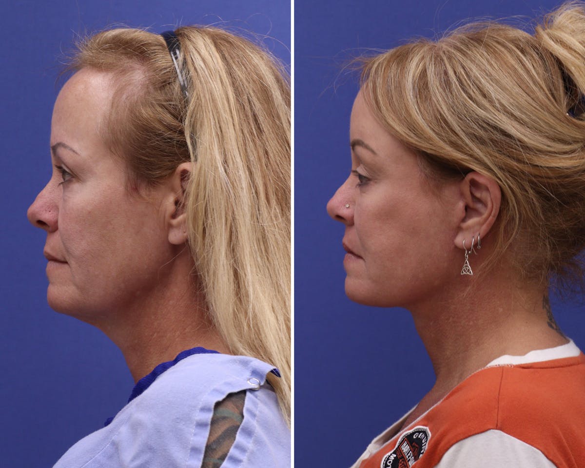 Facelift Before & After Gallery - Patient 376692 - Image 2