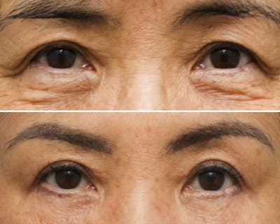 Blepharoplasty Before & After Gallery - Patient 241061 - Image 1