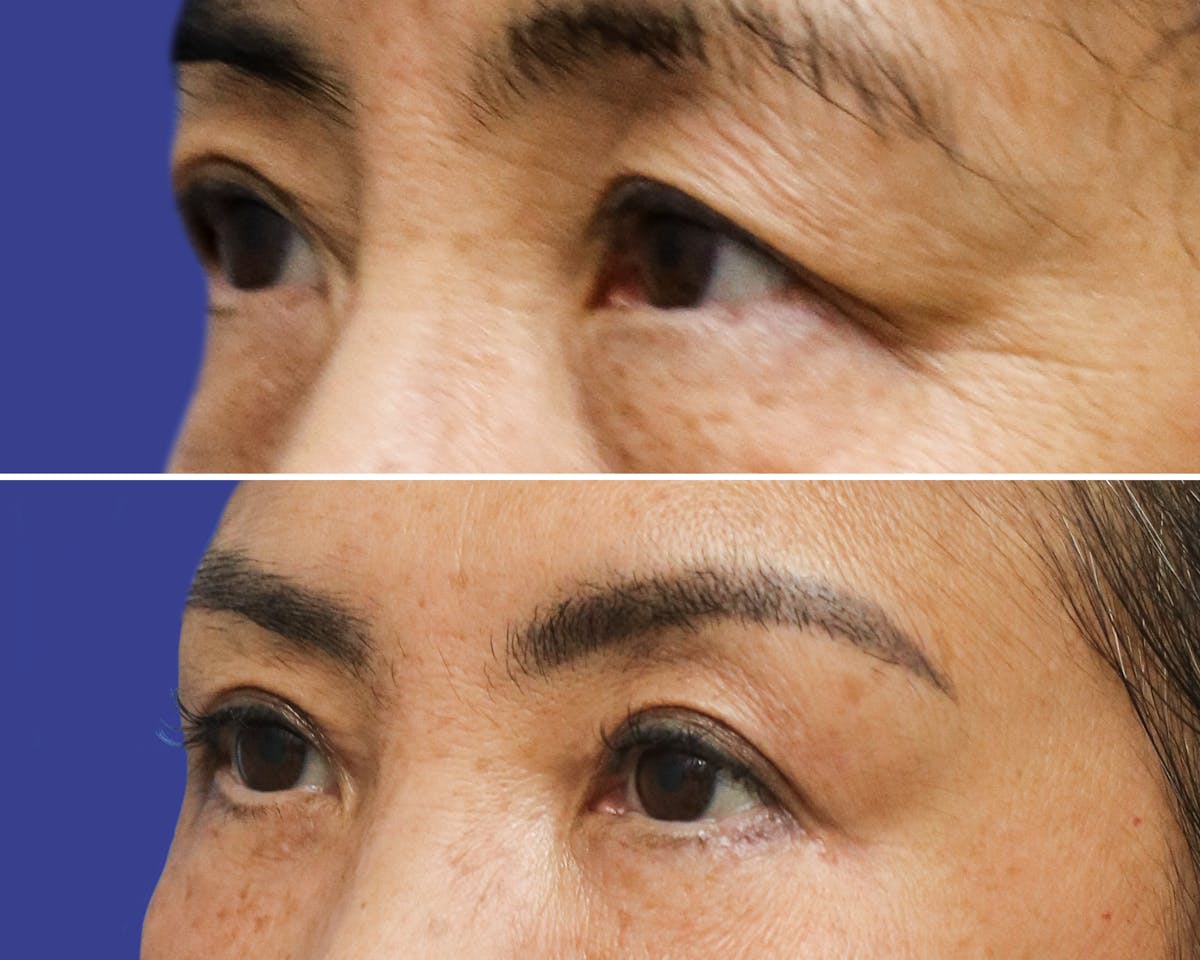 Blepharoplasty Before & After Gallery - Patient 241061 - Image 2
