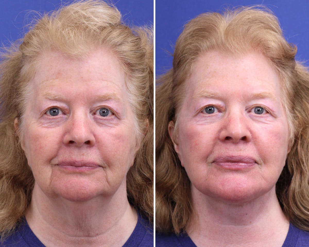 Facelift Before & After Gallery - Patient 351118 - Image 2