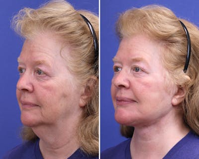 Facelift Before & After Gallery - Patient 351118 - Image 1
