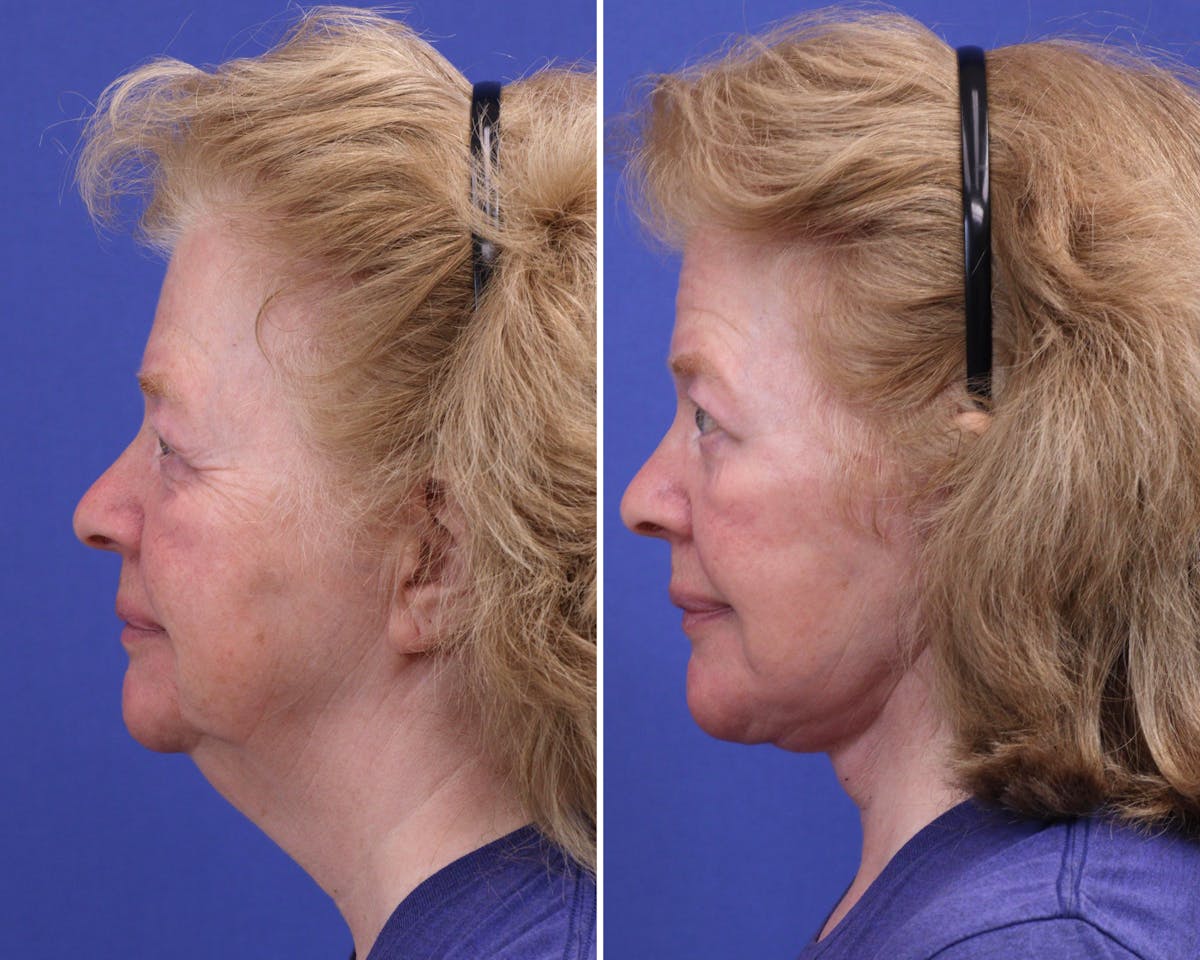 Facelift Before & After Gallery - Patient 351118 - Image 3