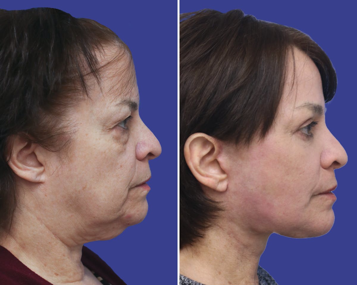 Facelift Before & After Gallery - Patient 102993 - Image 2