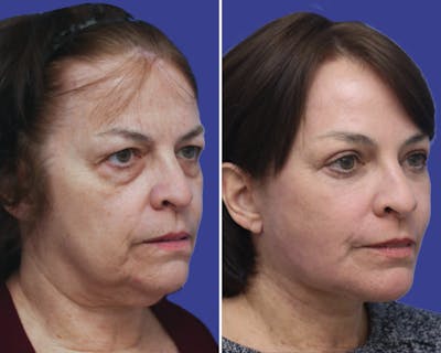 Facelift Before & After Gallery - Patient 102993 - Image 1