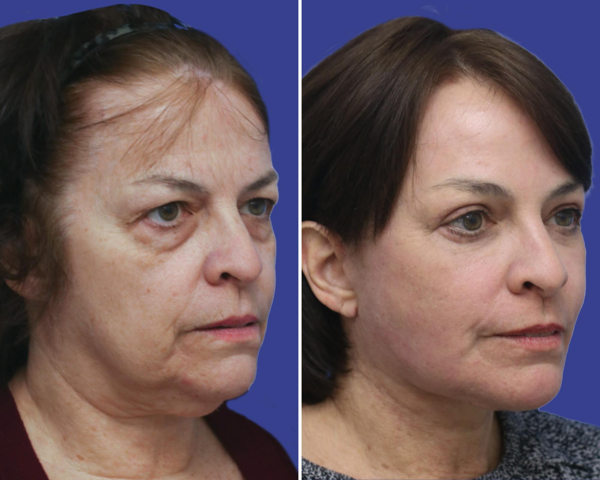 Face Before & After Gallery - Patient 965180 - Image 1