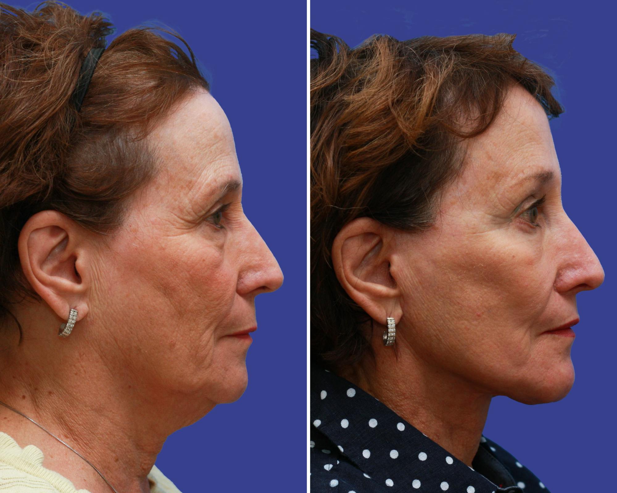 Face Before & After Gallery - Patient 196007 - Image 3