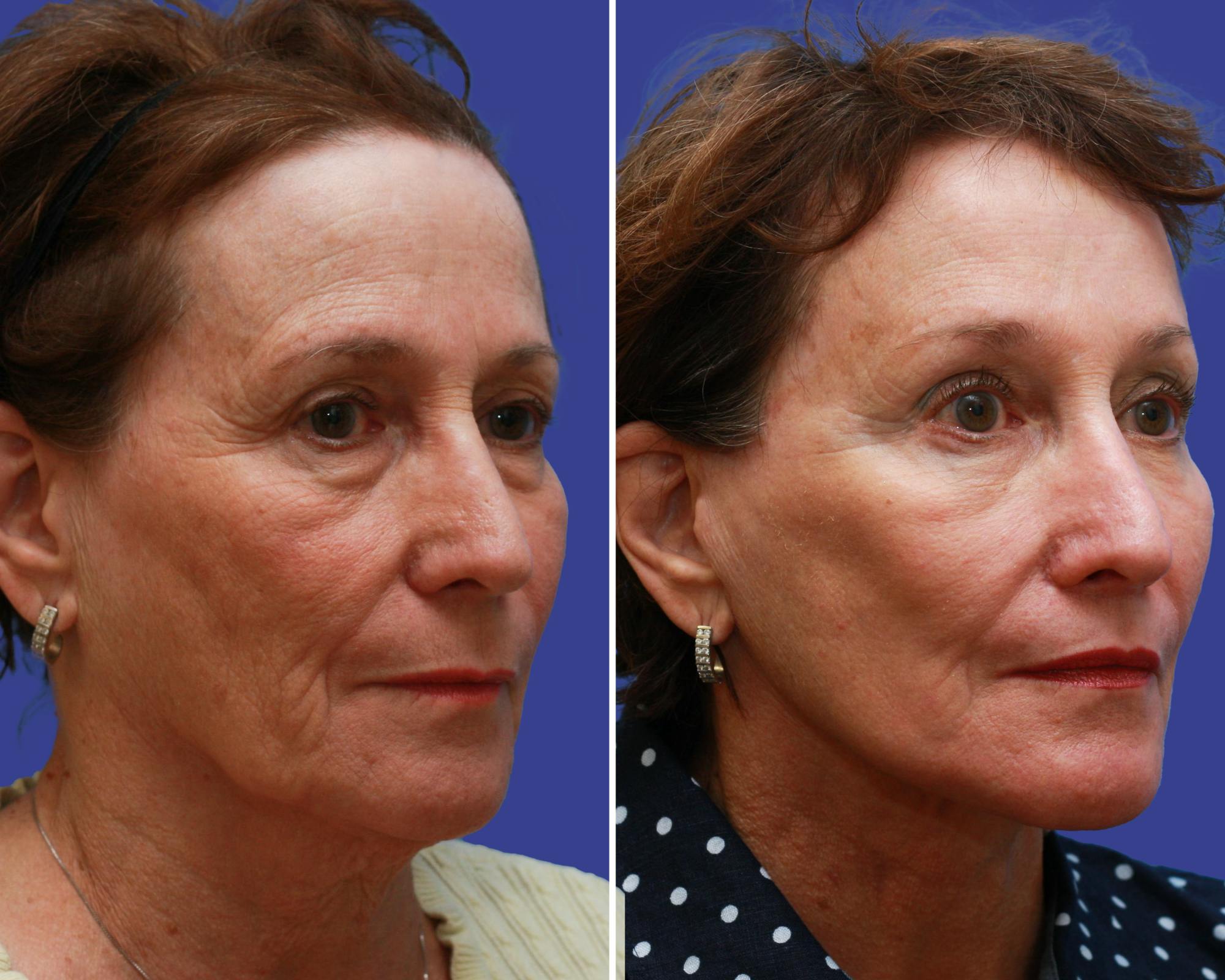 Face Before & After Gallery - Patient 196007 - Image 1