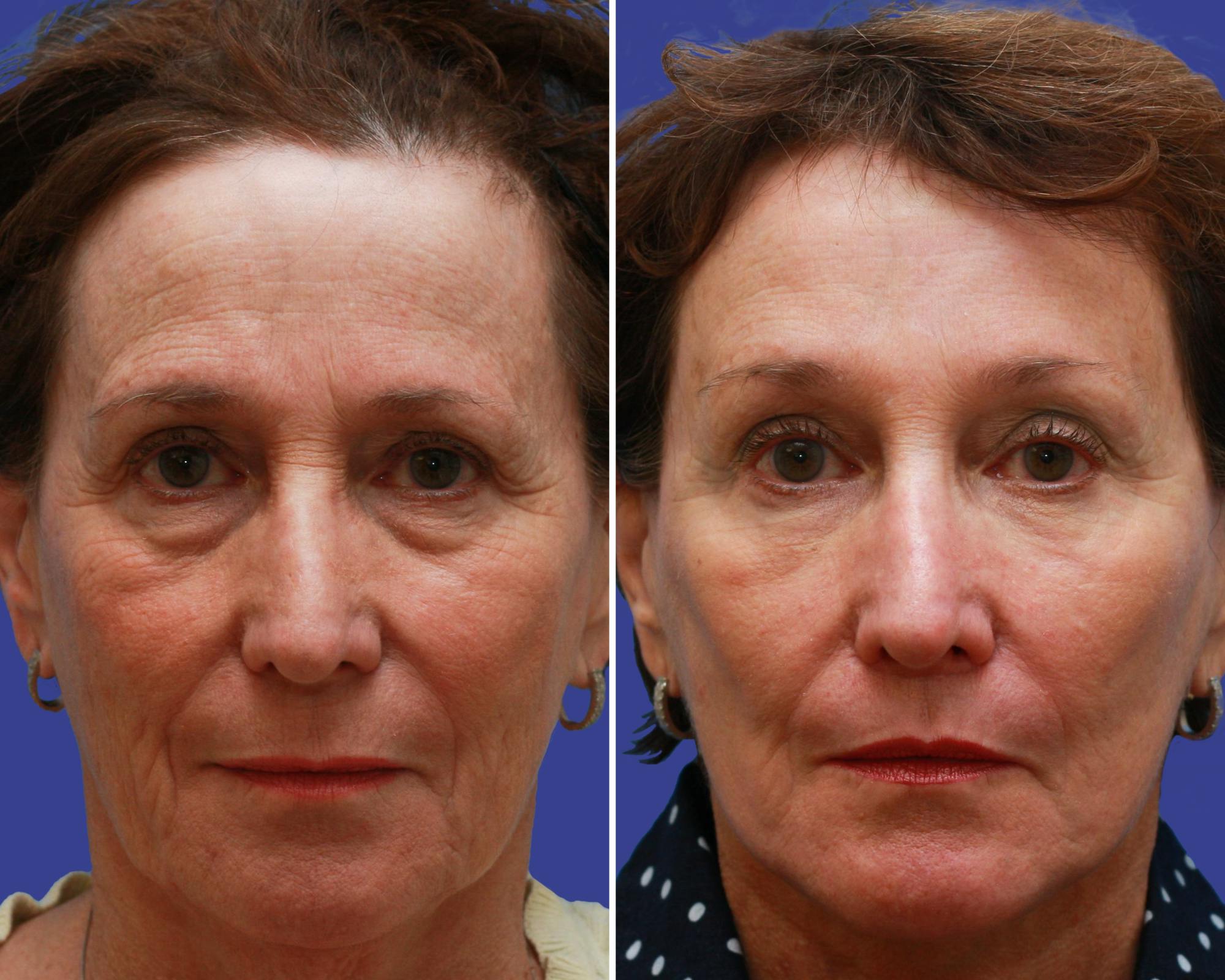 Face Before & After Gallery - Patient 196007 - Image 2