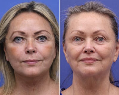 Lips Before & After Gallery - Patient 639173 - Image 1