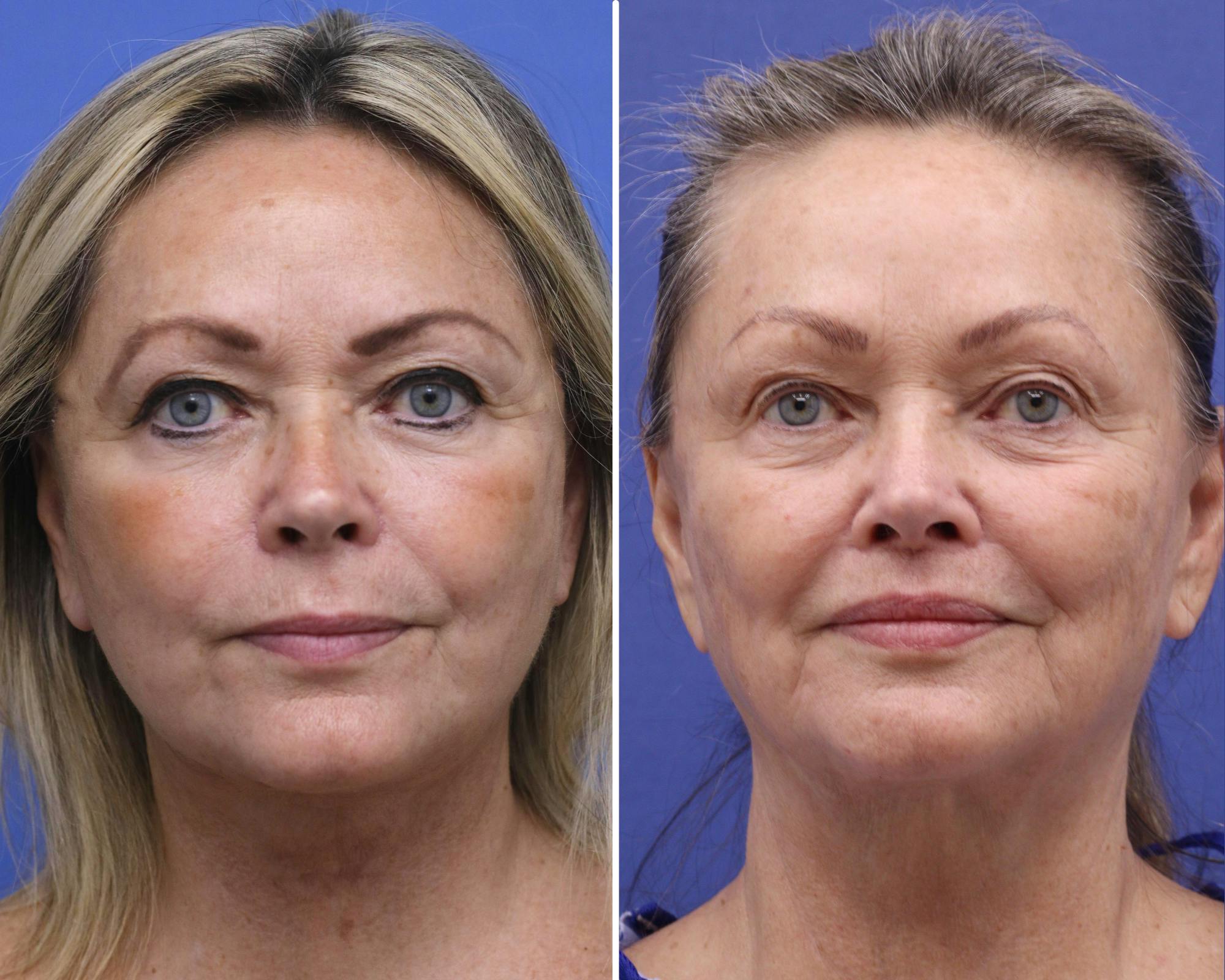 Lip Lift Before & After Gallery - Patient 349987 - Image 1