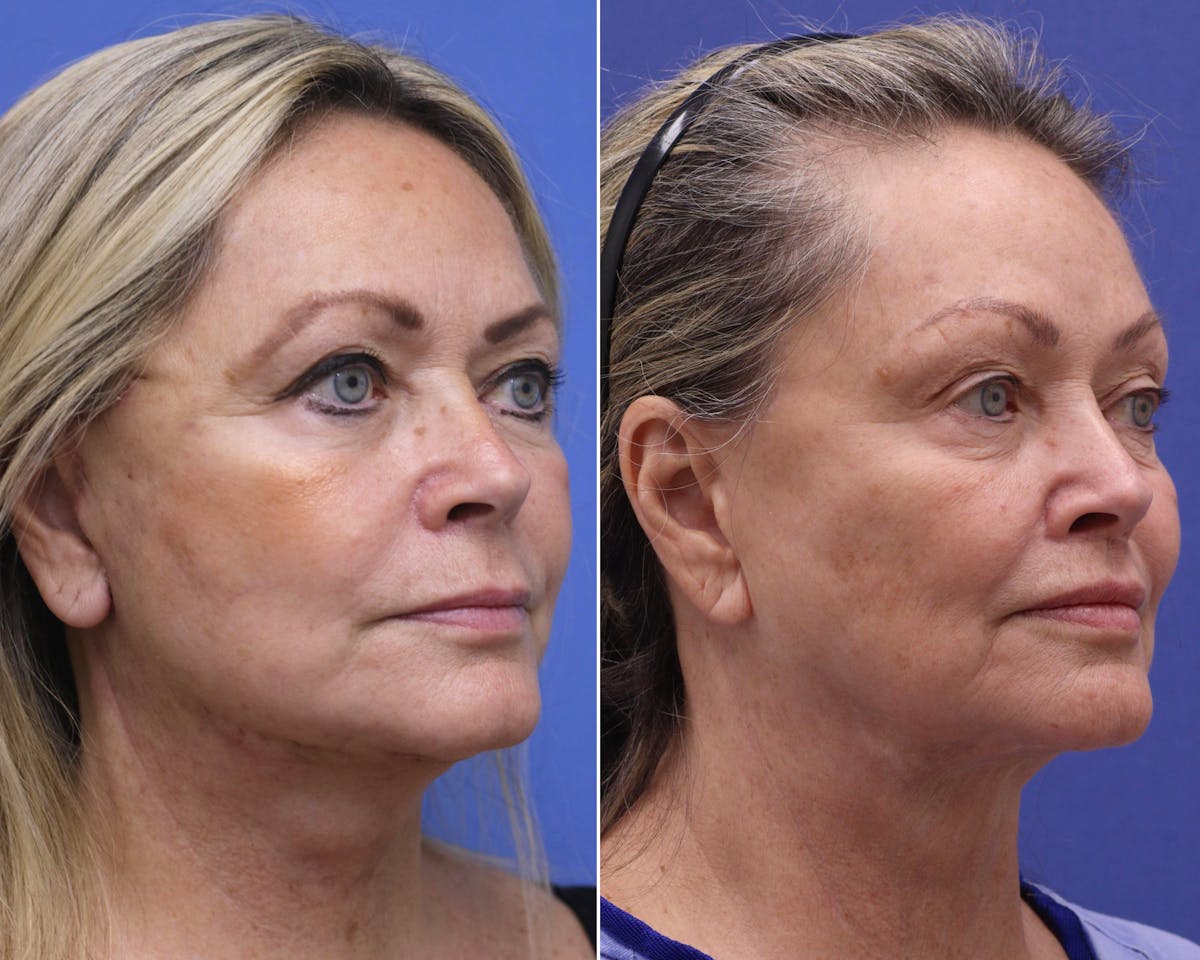 Lips Before & After Gallery - Patient 639173 - Image 2