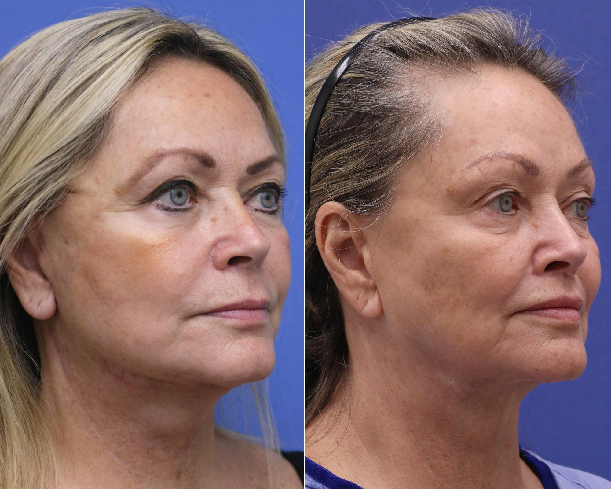 Lip Lift Before & After Gallery - Patient 349987 - Image 2