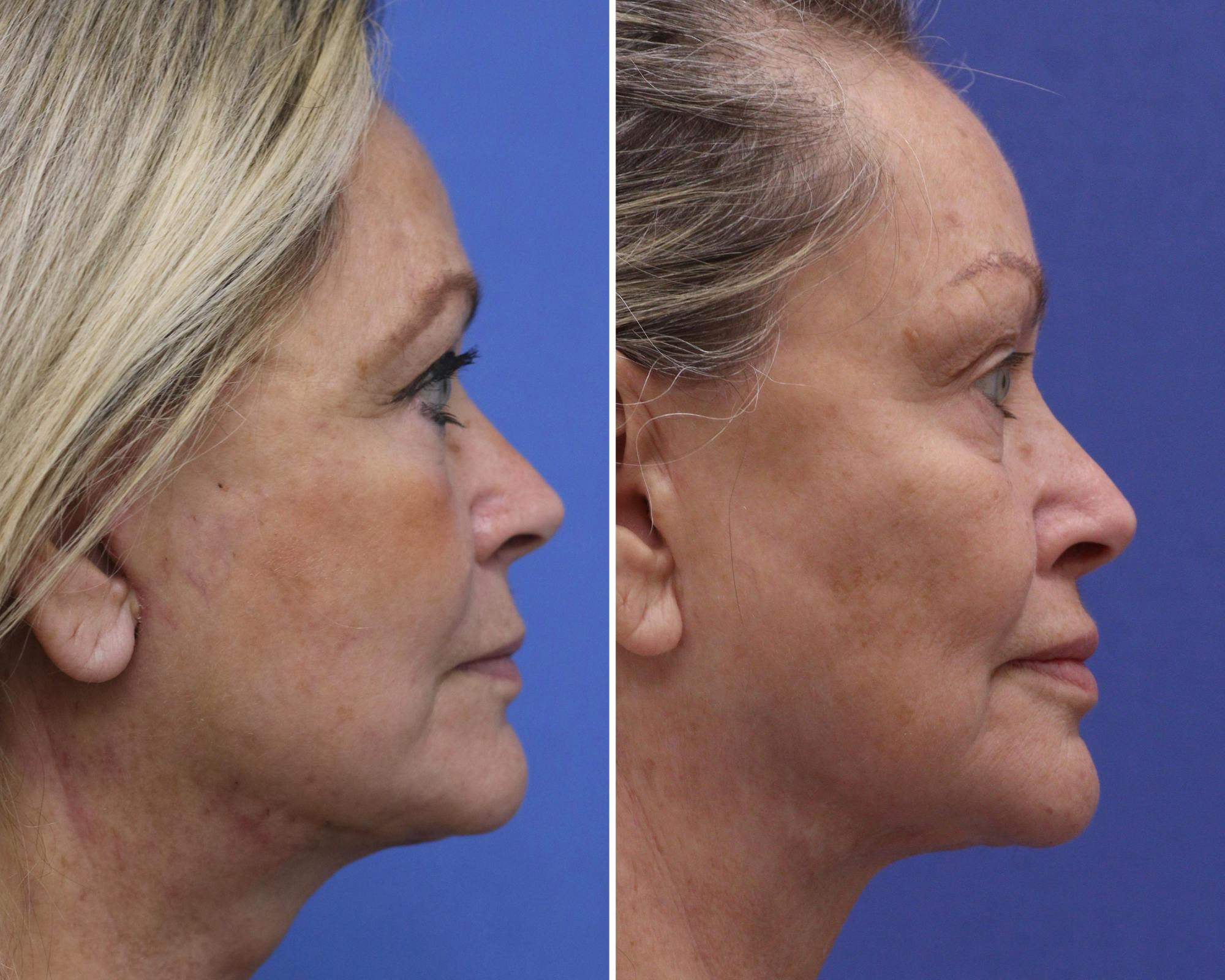 Lip Lift Before & After Gallery - Patient 349987 - Image 3