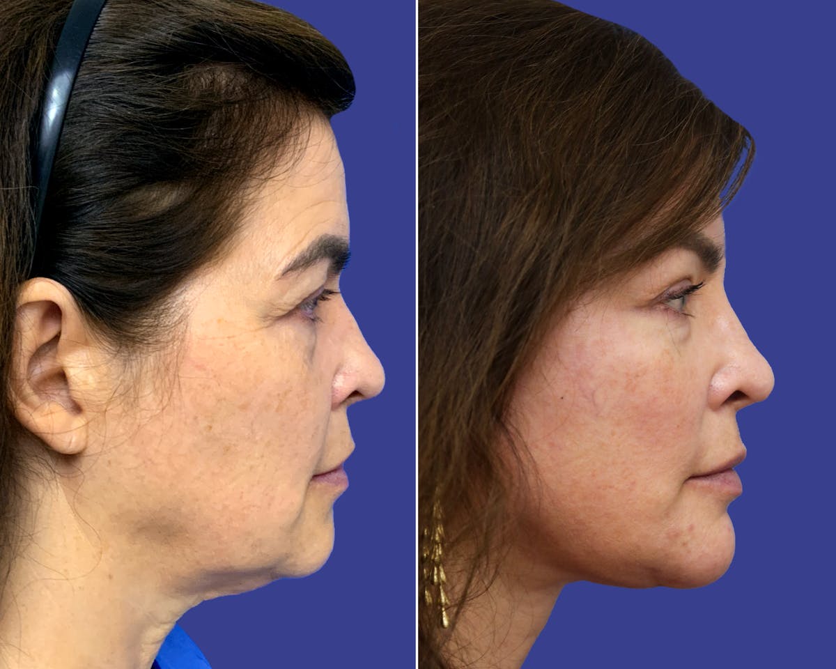 Neck Before & After Gallery - Patient 241006 - Image 2