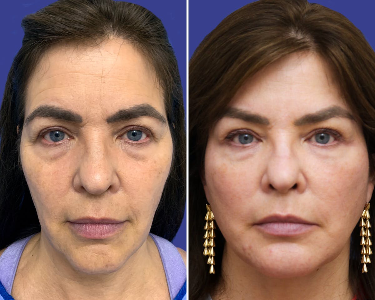 Neck Before & After Gallery - Patient 241006 - Image 3
