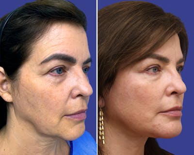 Neck Before & After Gallery - Patient 241006 - Image 1