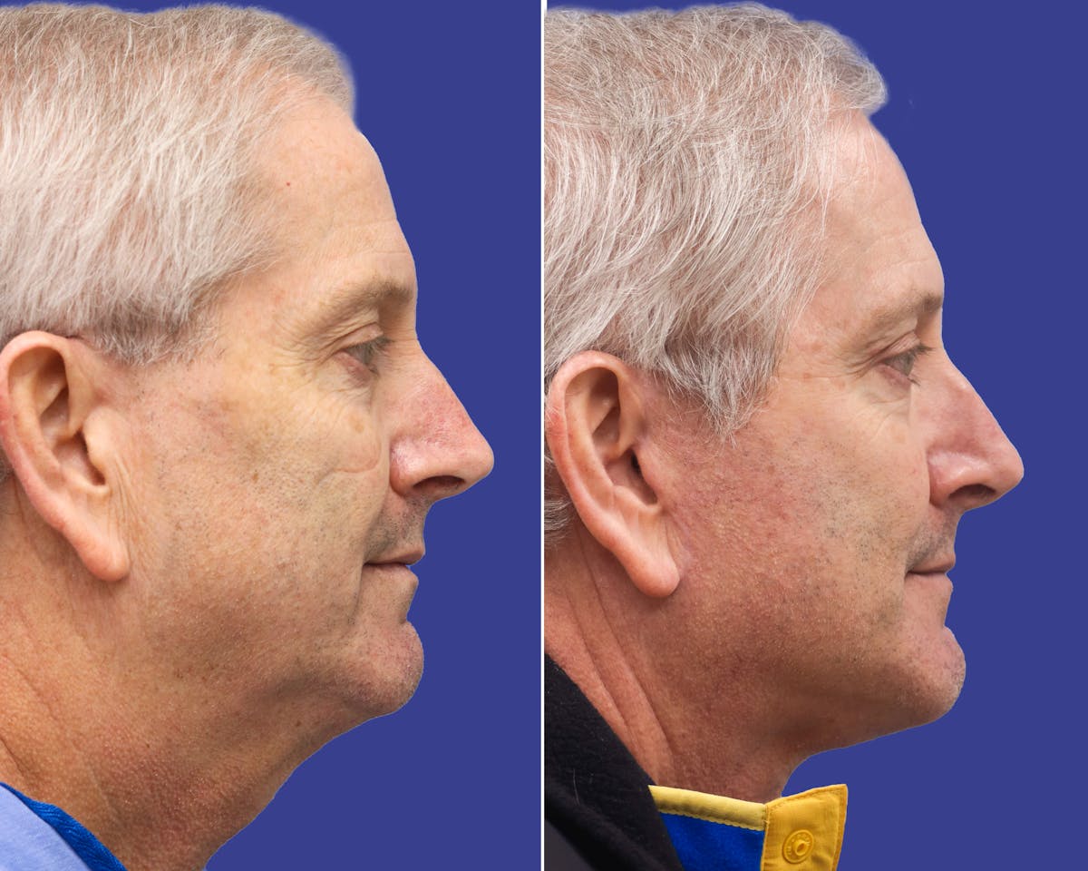 Neck Before & After Gallery - Patient 357136 - Image 2