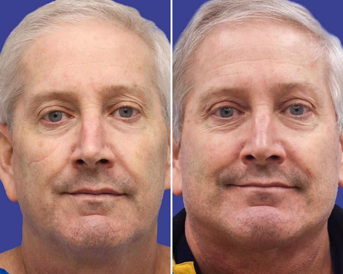 Neck Before & After Gallery - Patient 357136 - Image 3