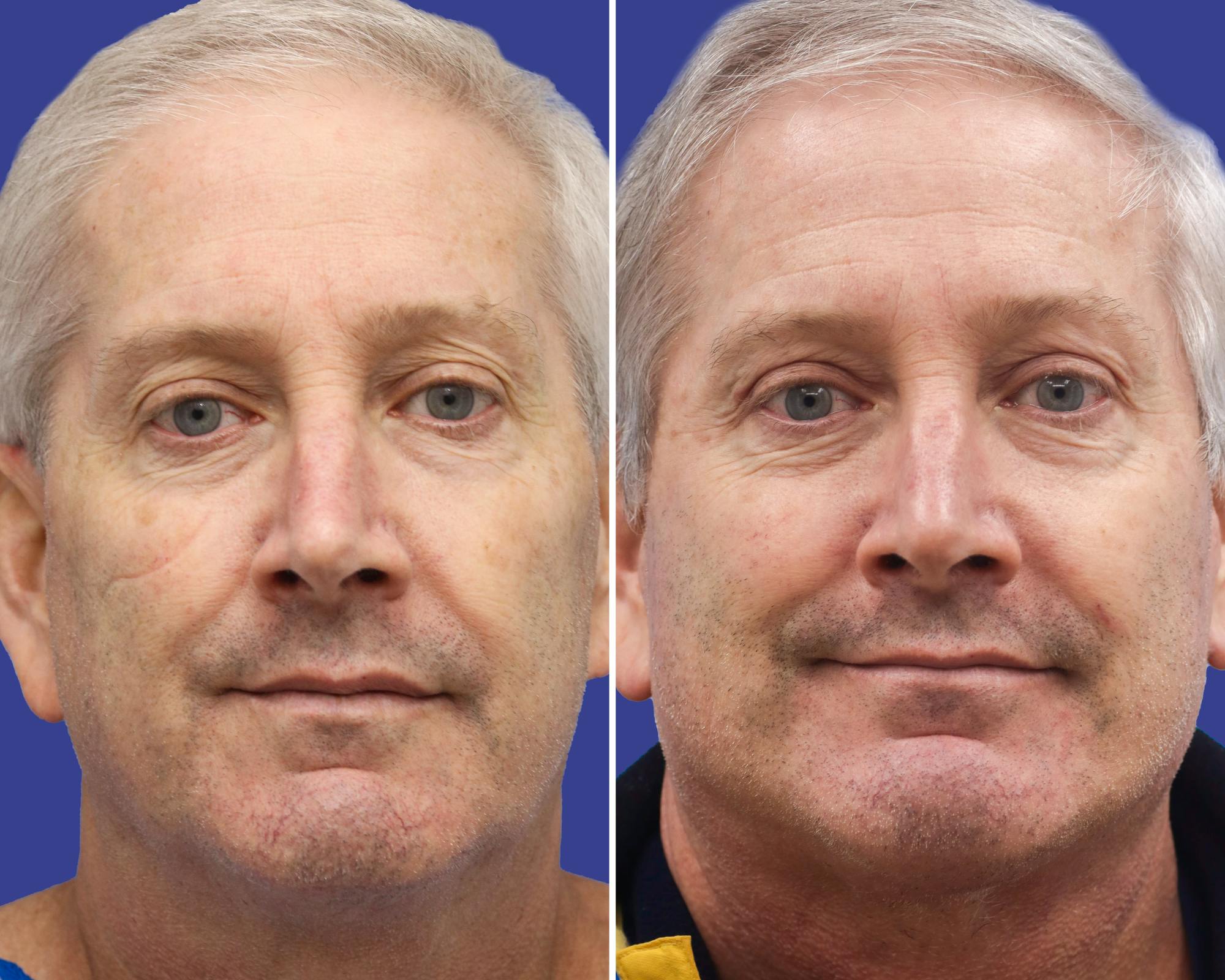 Neck Lift Before & After Gallery - Patient 337384 - Image 3