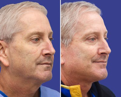 Neck Before & After Gallery - Patient 357136 - Image 1