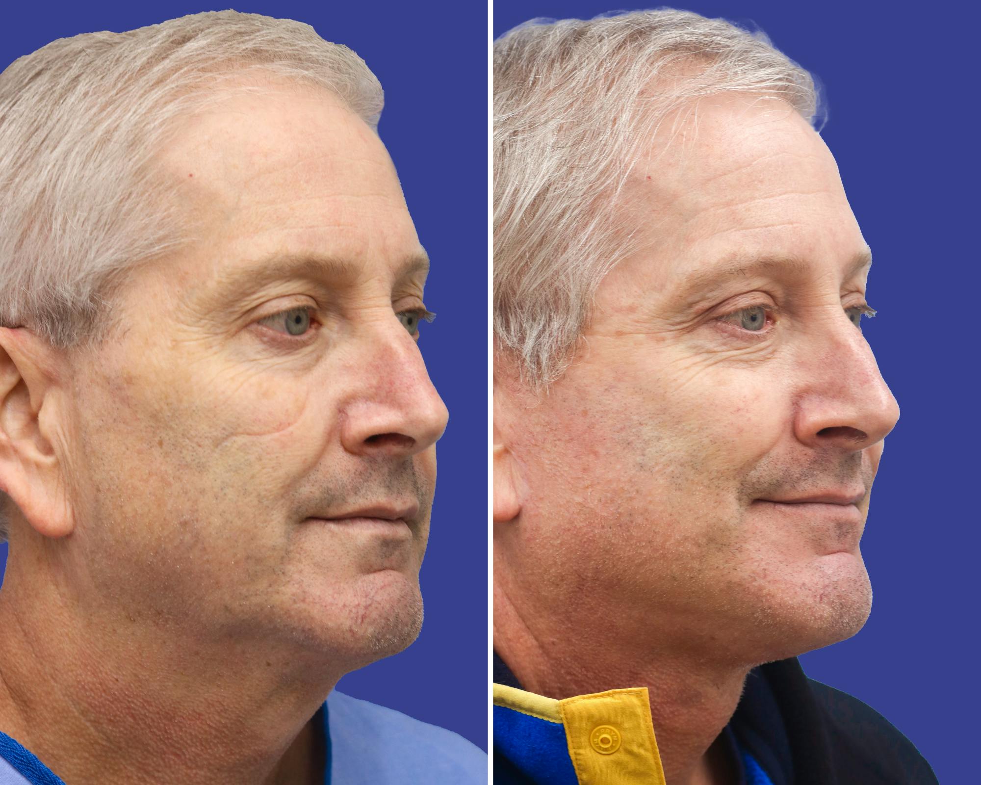 Neck Lift Before & After Gallery - Patient 337384 - Image 1