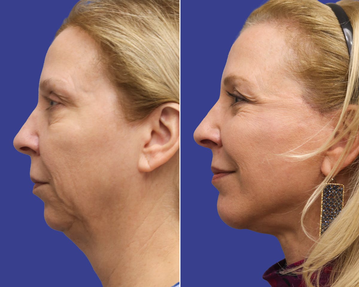 Neck Lift Before & After Gallery - Patient 378375 - Image 2