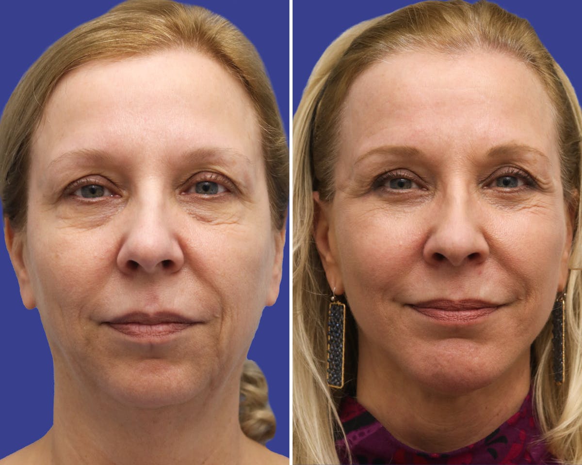 Neck Lift Before & After Gallery - Patient 378375 - Image 3