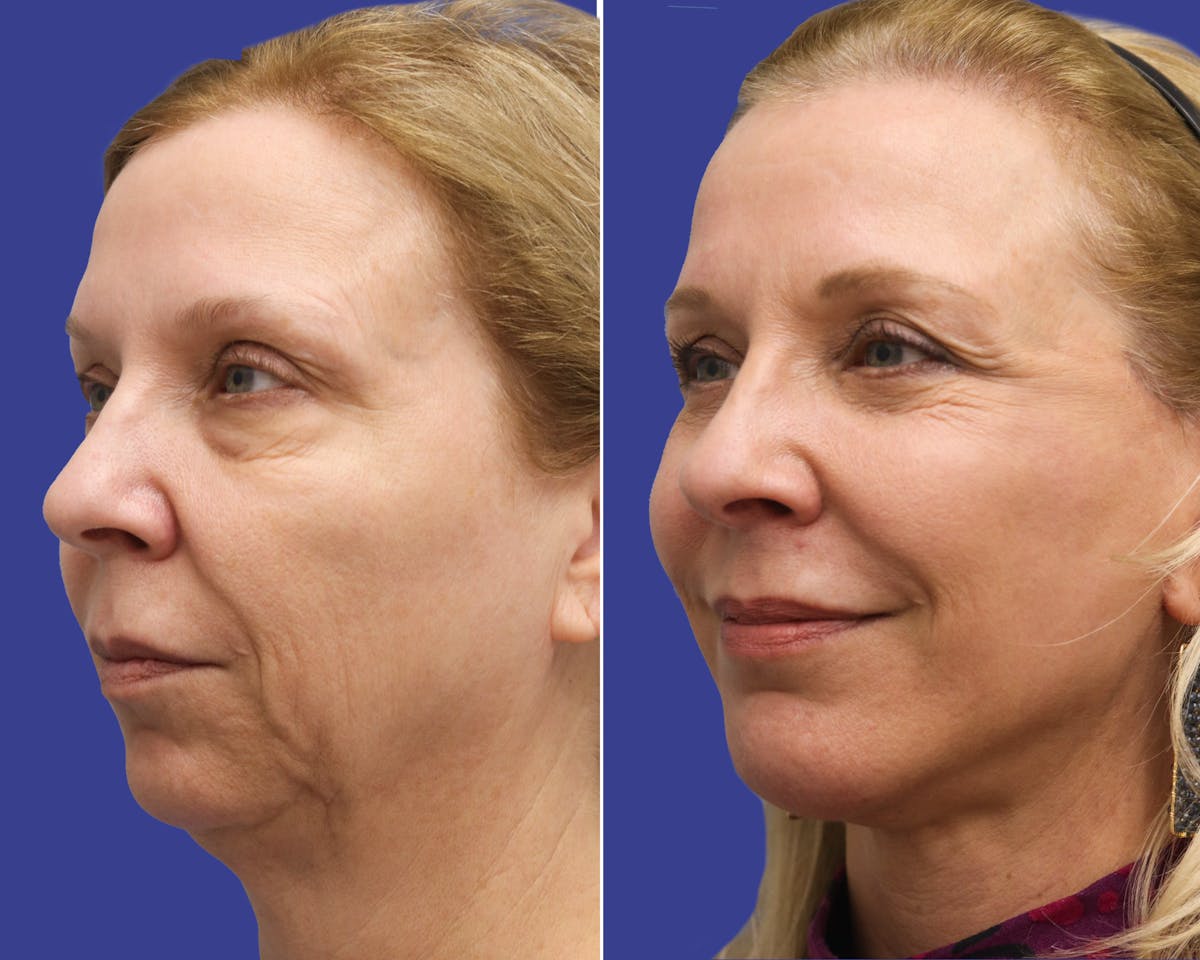 Neck Lift Before & After Gallery - Patient 378375 - Image 1