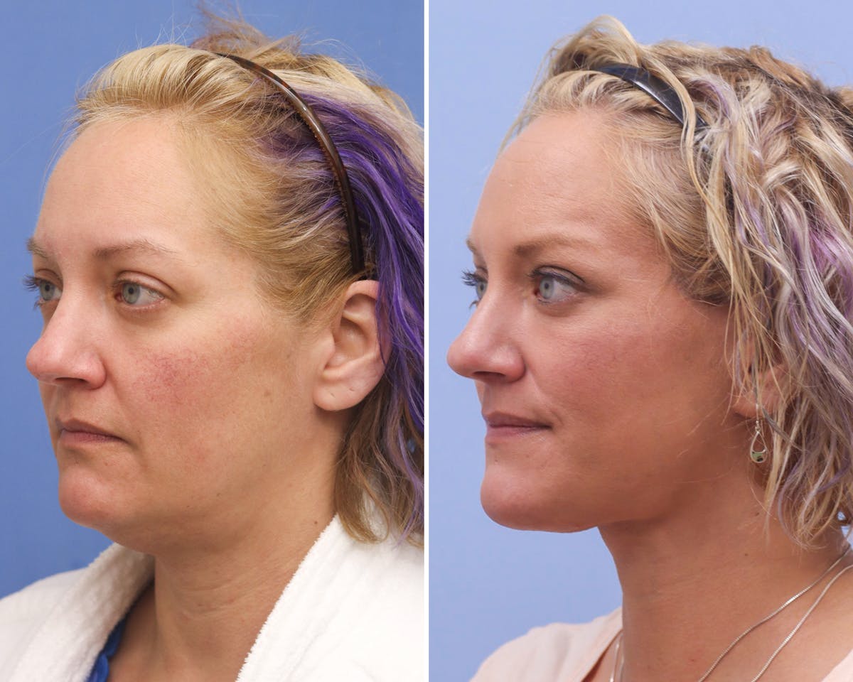 Neck Before & After Gallery - Patient 244936 - Image 1