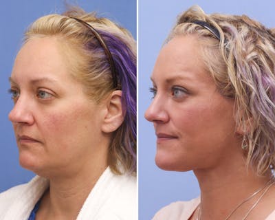 Neck Before & After Gallery - Patient 244936 - Image 1
