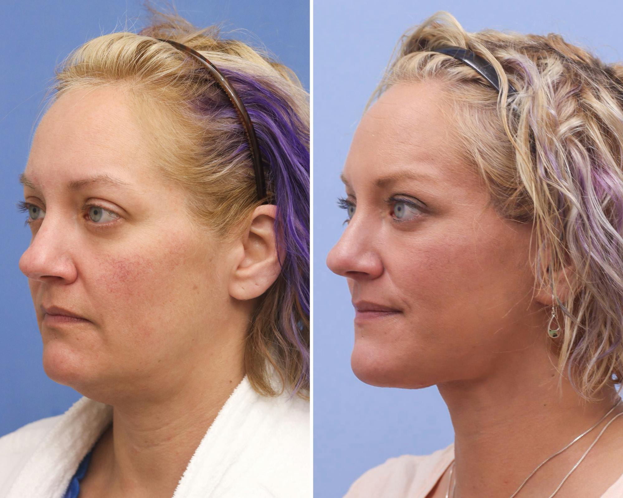 Neck Lift Before & After Gallery - Patient 372965 - Image 1