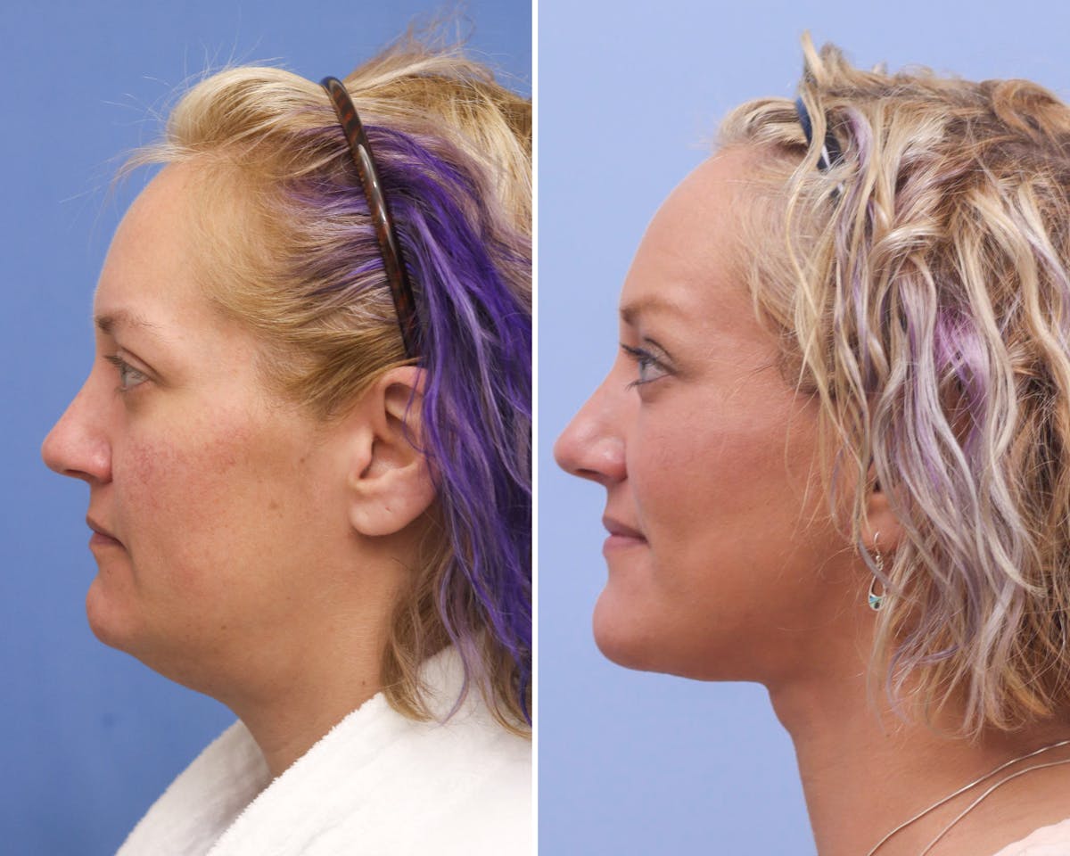 Neck Before & After Gallery - Patient 244936 - Image 2
