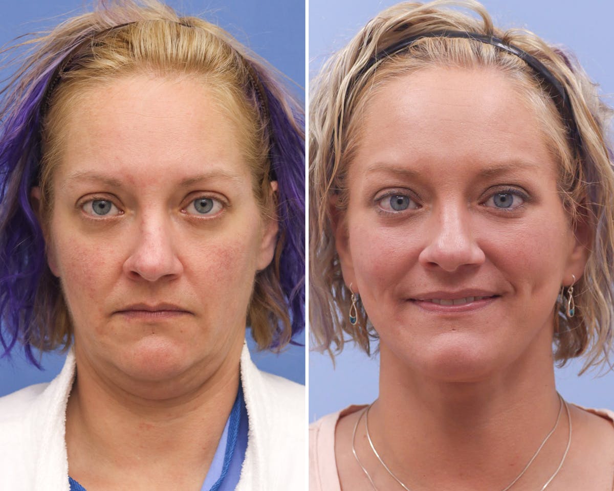 Neck Before & After Gallery - Patient 244936 - Image 3