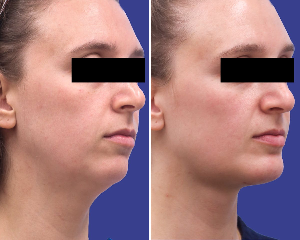 Neck Before & After Gallery - Patient 154070 - Image 1