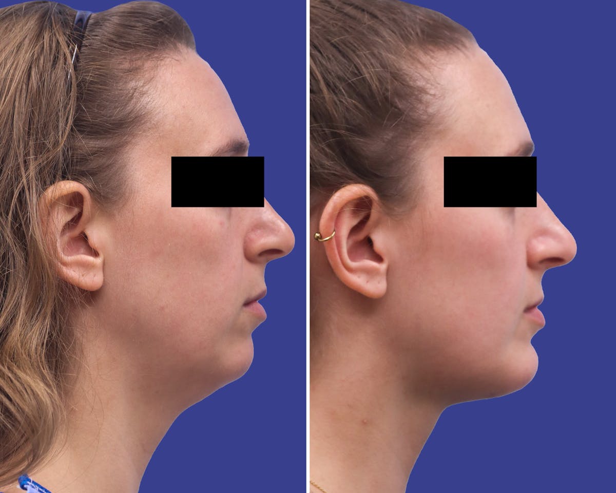 Neck Before & After Gallery - Patient 154070 - Image 2