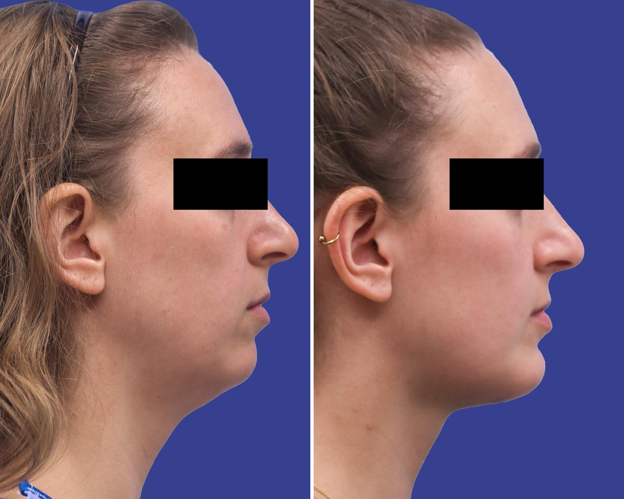Neck Lift Before & After Gallery - Patient 413622 - Image 2