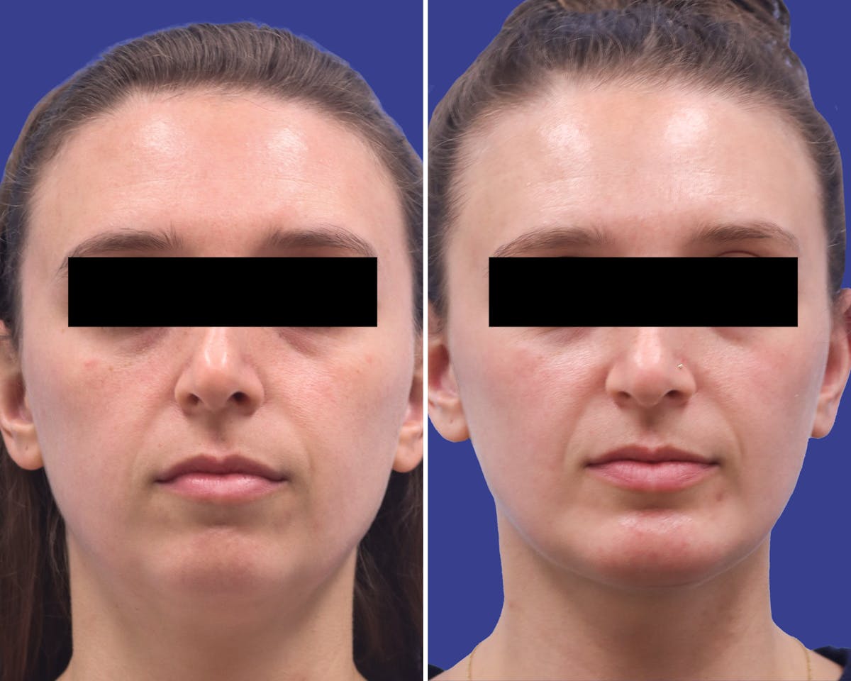 Neck Before & After Gallery - Patient 154070 - Image 3