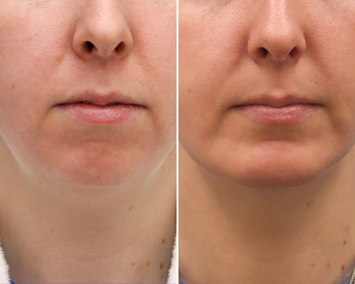 Neck Before & After Gallery - Patient 216636 - Image 3